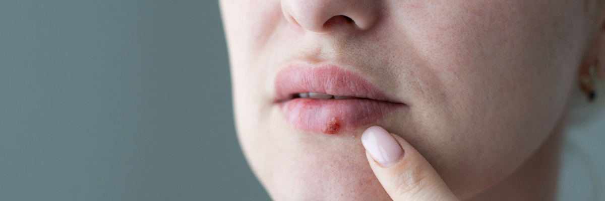 Genital Herpes Ayurveda